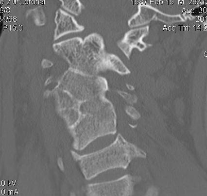 Klippel Feil CT Coronal